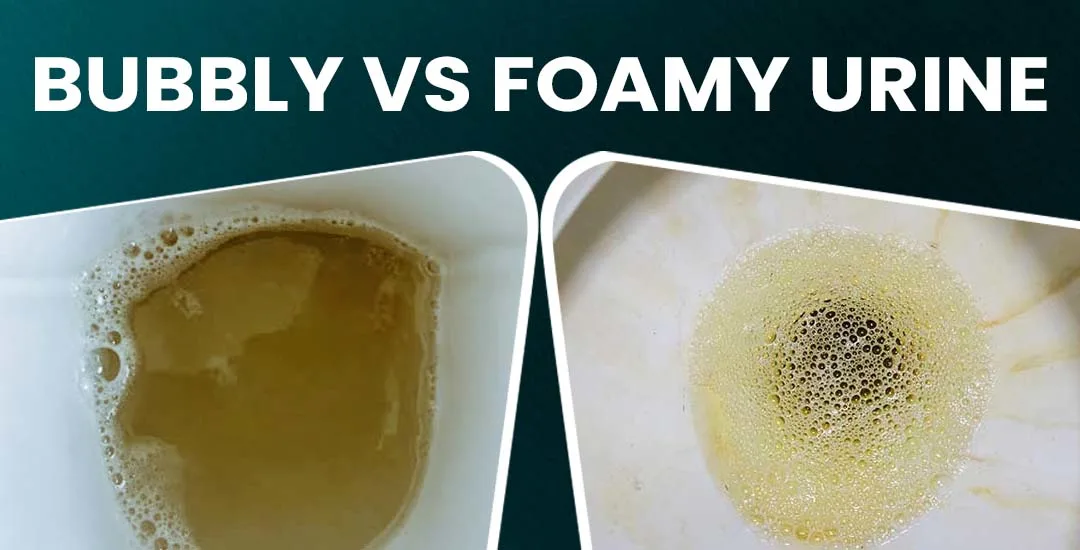 Bubbly vs Foamy Urine: Differences, Causes & When to See a Doctor Bubbly vs Foamy Urine: Differences, Causes & When to See a Doctor